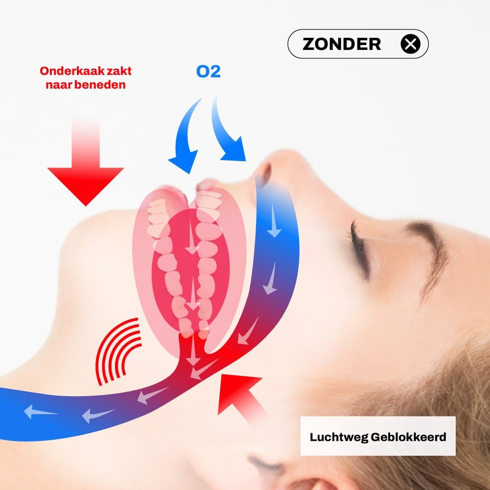 Miss Anti Snurk - Zonder Beugel